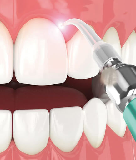 IMG-Teeth-Whitening