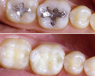 Benefits-Of-Mercury-Free-Removal