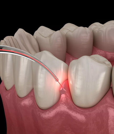 img-Gum-Disease-Treatment