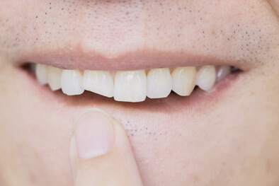 img-Knocked-Out-Teeth