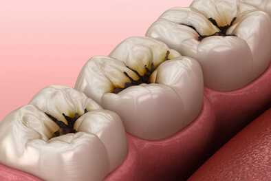 img-Large-Cavities