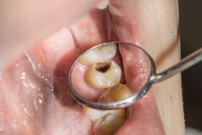 img-Tooth-Abscess