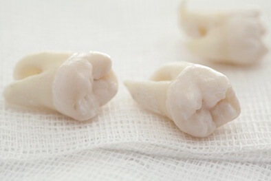 img-What-Is-An-Oral-Surgery-Extraction