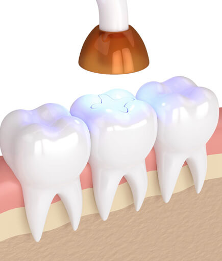 img-Why-Are-Sealants-Needed