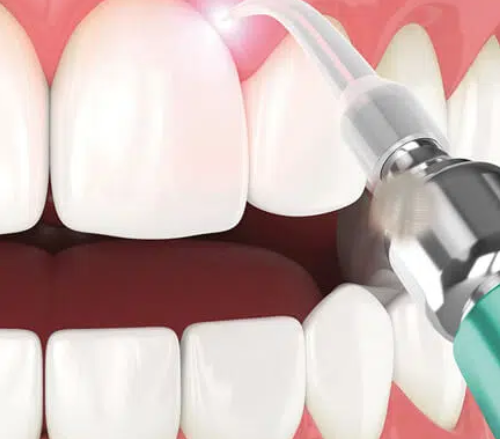 Teeth-Whitening
