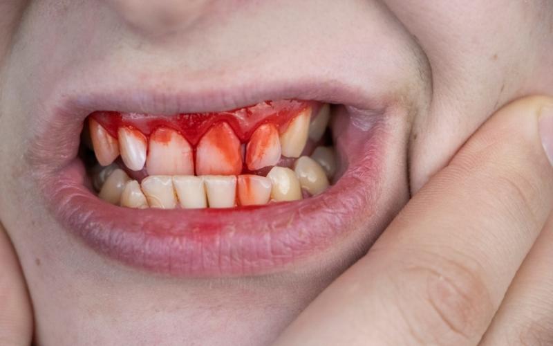 Emergency Dentistry - KEA Smile Studio Of Tampa, FL