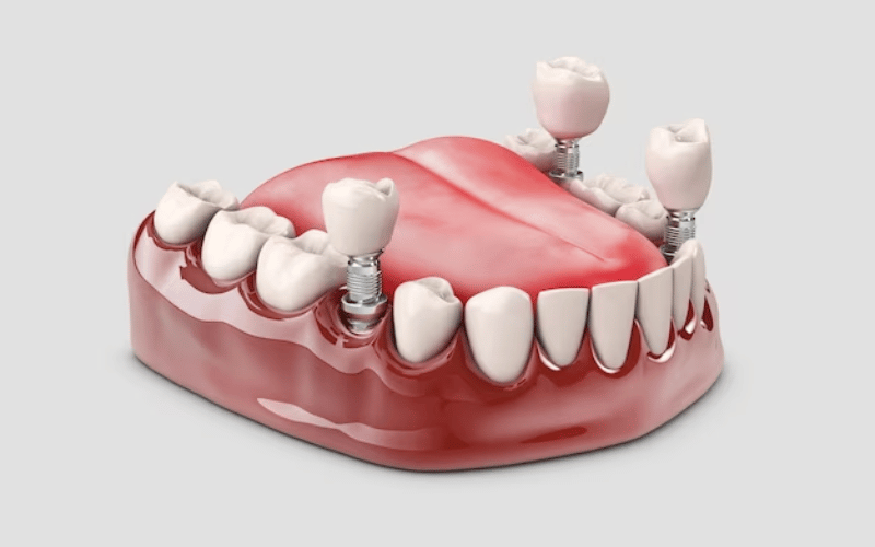 Dental Implants - KEA Smile Studio Of Tampa